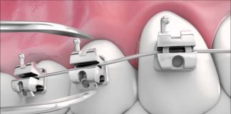 ¿Hay ventajas con los brackets de auto-ligado? auto-ligado